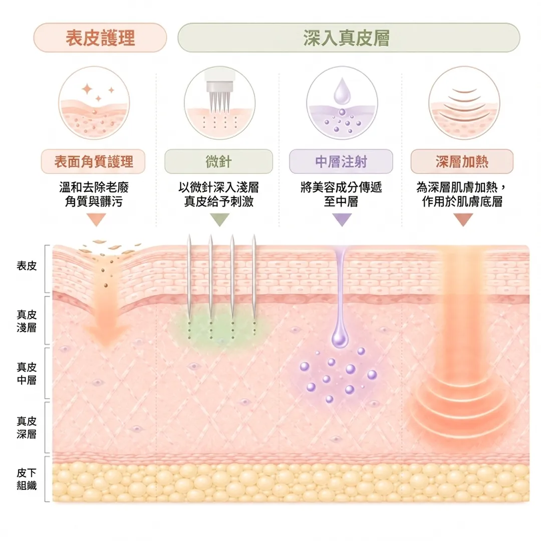毛穴アプローチの層別比較-以微針深入淺層真皮-老廢角質與髒污-表面角質護理-深入真皮層-zh-tw.webp