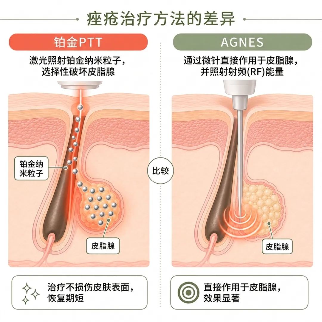 江南美容皮膚科-通过微针直接作用于皮脂腺，并照射射频-RF-能量-zh-cn.webp