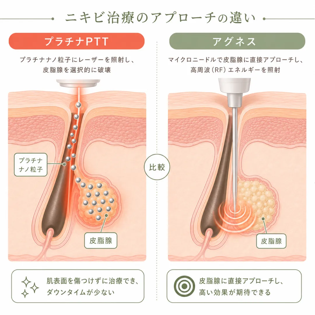 江南美容皮膚科_プラチナPTTとアグネス(微細針)の皮膚層における作用メカニズムの違いを示した比較図.webp