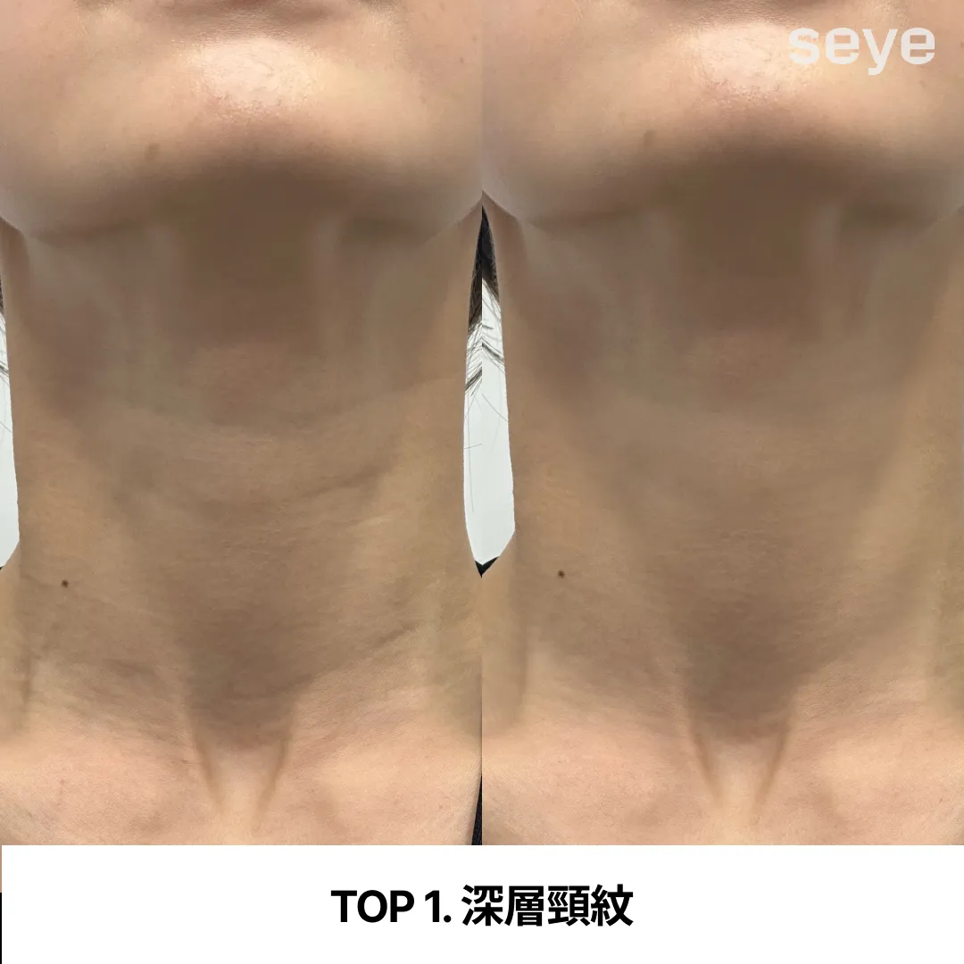 深層頸紋.webp