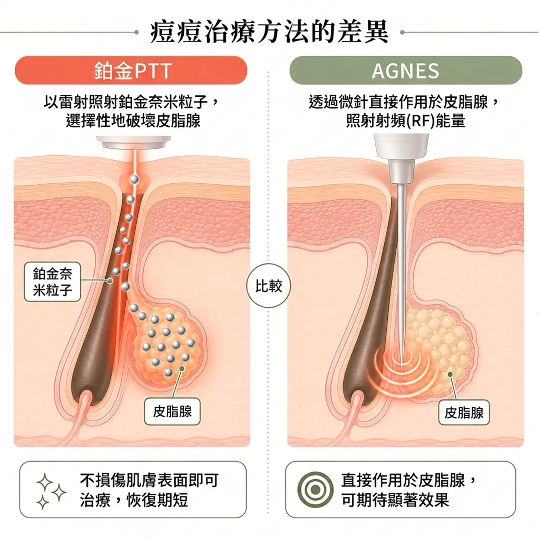 照射射頻-RF-能量-透過微針直接作用於皮脂腺-以雷射照射鉑金奈米粒子-zh-tw.webp
