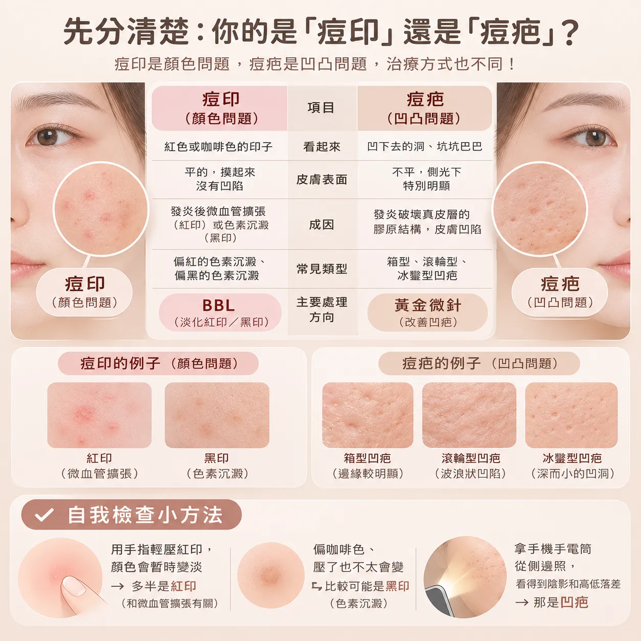痘印與痘疤辨識圖鑑：紅印、黑印、箱型凹疤、滾輪型凹疤、冰鑿型凹疤的區別