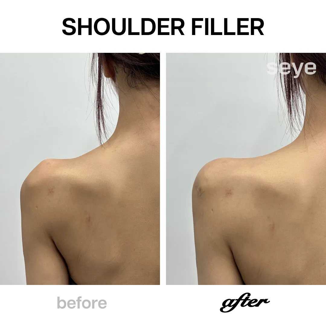 直角肩玻尿酸效果-shoulder-filler-vs-comparison-seyeclinic.webp