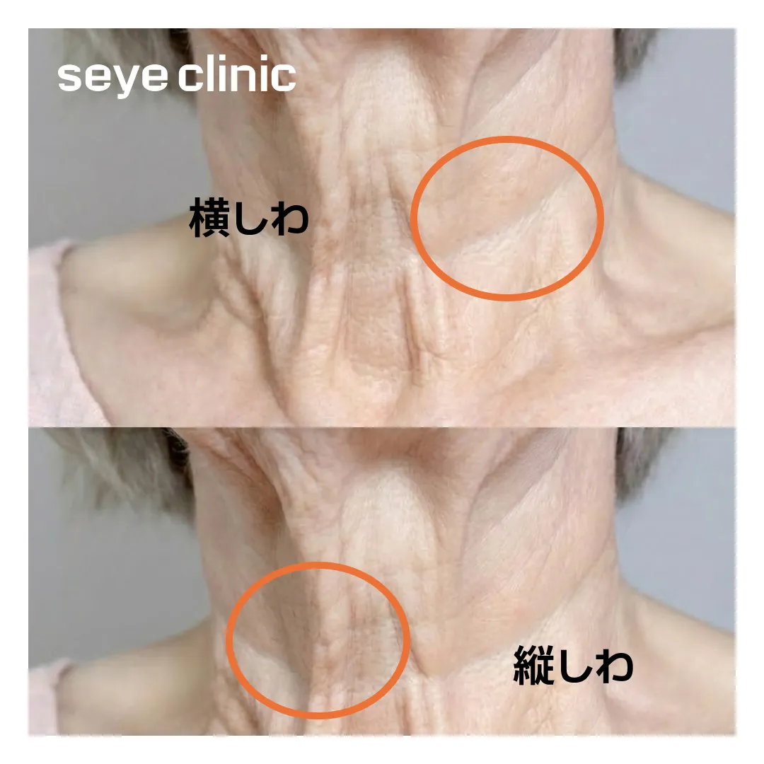 縦のしわ横のしわ違い.webp