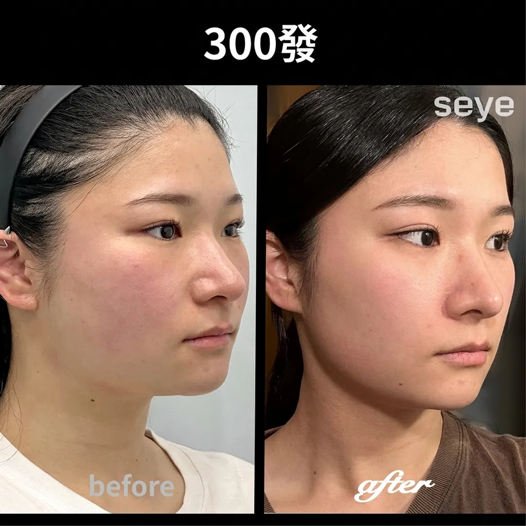 美国音波before-after-300發-seye-zh-tw-症例写真-before-after-300發-seye-zh-tw.webp