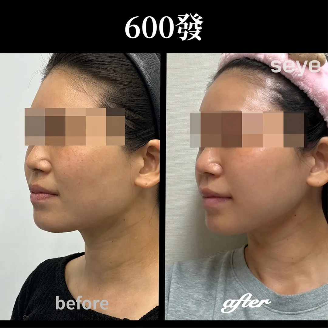 美国音波before-after-seye-zh-tw-before-after-600發-seye-zh-tw症例写真-before-after-600發-seye-zh-tw.webp