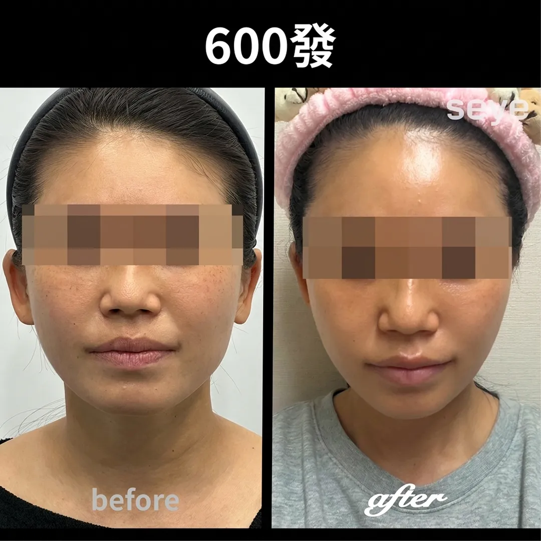 美国音波before-after-seye-zh-tw-before-after-600發-seye-zh-tw.webp
