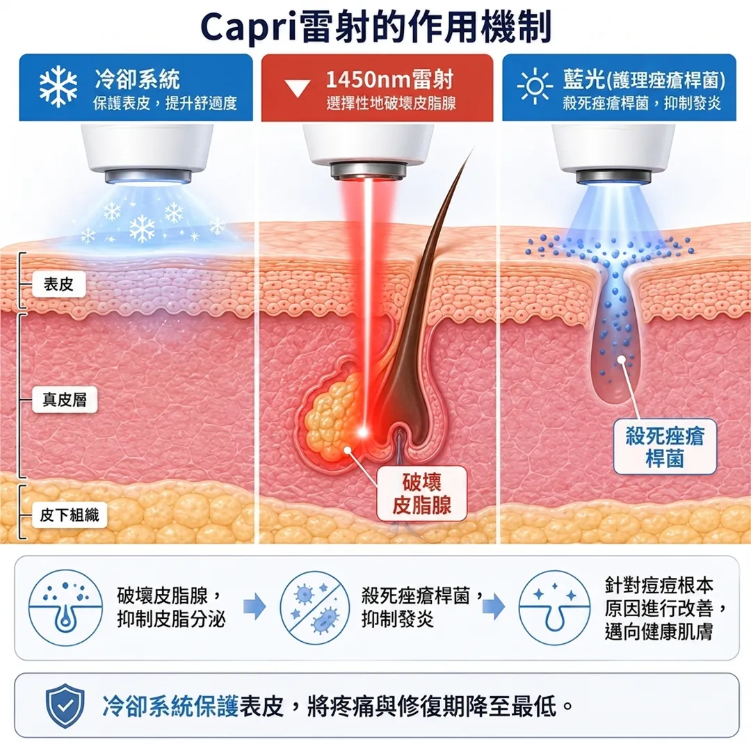 藍光-護理痤瘡桿菌-Capri雷射的作用機制-殺死痤瘡桿菌，抑制發炎-保護表皮，提升舒適度-zh-tw.webp