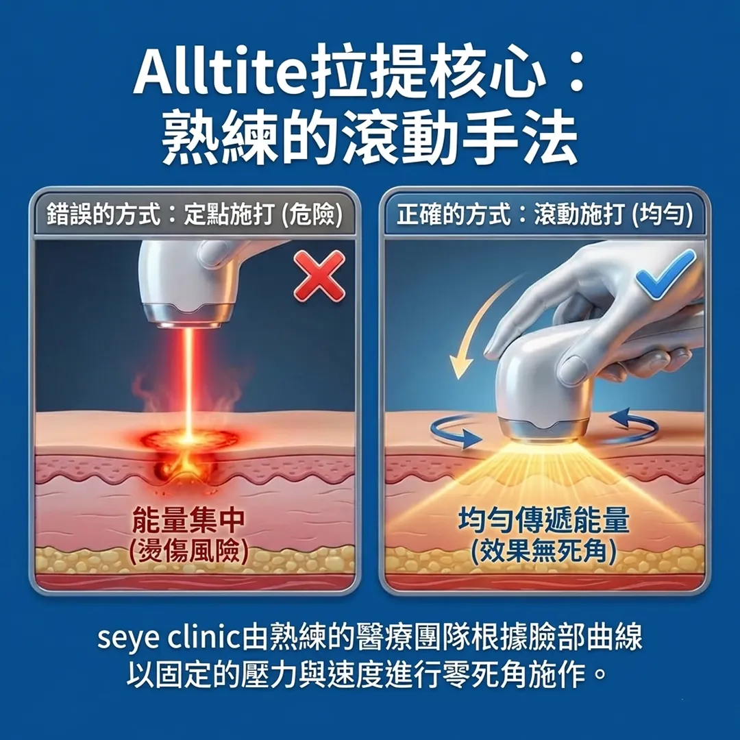 診所-錯誤的方式:定點施打-危險-正確的方式:滾動施打-均勻-Alltite拉提核心:-熟練的滾動手法.webp