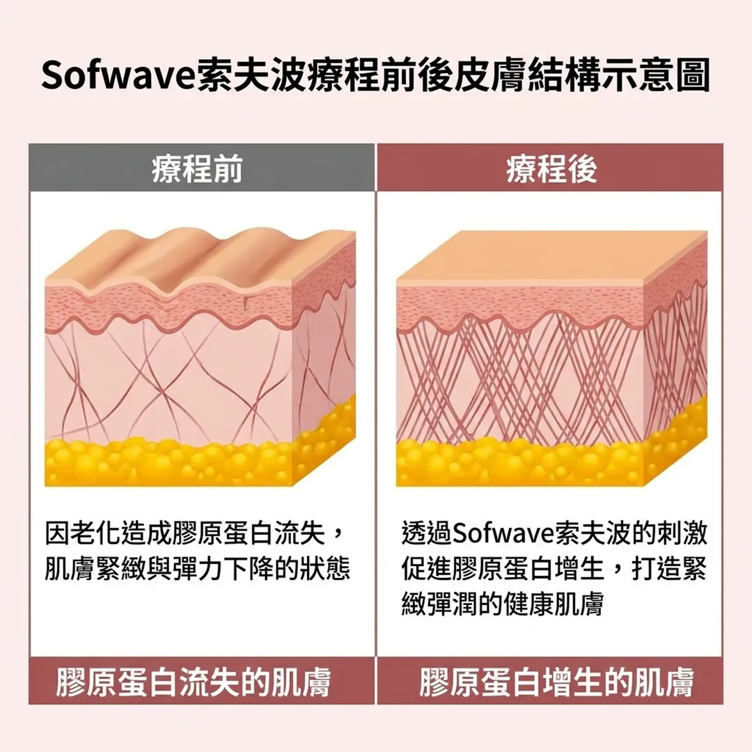 透過Sofwave索夫波的刺激促進膠原蛋白增生,打造緊緻彈潤的健康肌膚-因老化造成膠原蛋白流失,肌膚緊緻與彈力下降的狀態-zh-tw.webp