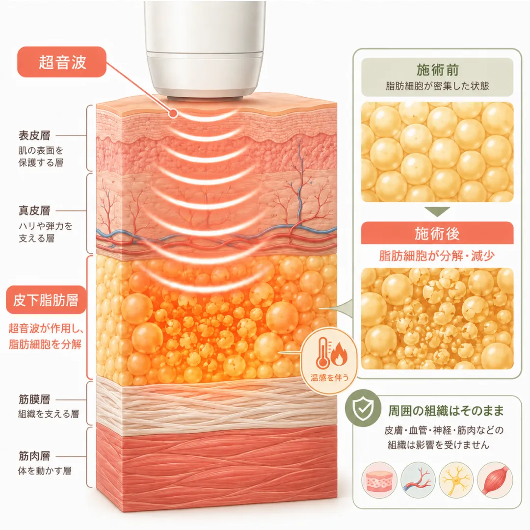 韓国美容皮膚科_チューンボディの作用メカニズム.webp