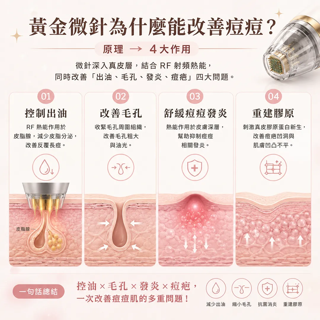 黃金微針為什麼能改善痘痘皮脂腺調控毛孔收縮膠原重建機制說明圖-why-gold-rf-microneedling-helps-acne-sebaceous-pores-collagen-mechanism-seyeclinic.webp