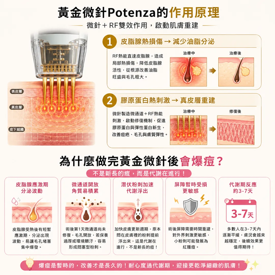 黃金微針Potenza-RF射頻微針複合皮脂腺熱損傷膠原蛋白重建再生原理說明圖-potenza-rf-microneedling-sebaceous-gland-heat-collagen-remodeling-mechanism-seyeclinic.webp
