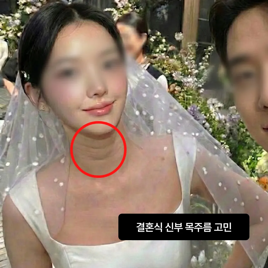 결혼 예신 피부과 시술 목주름.webp