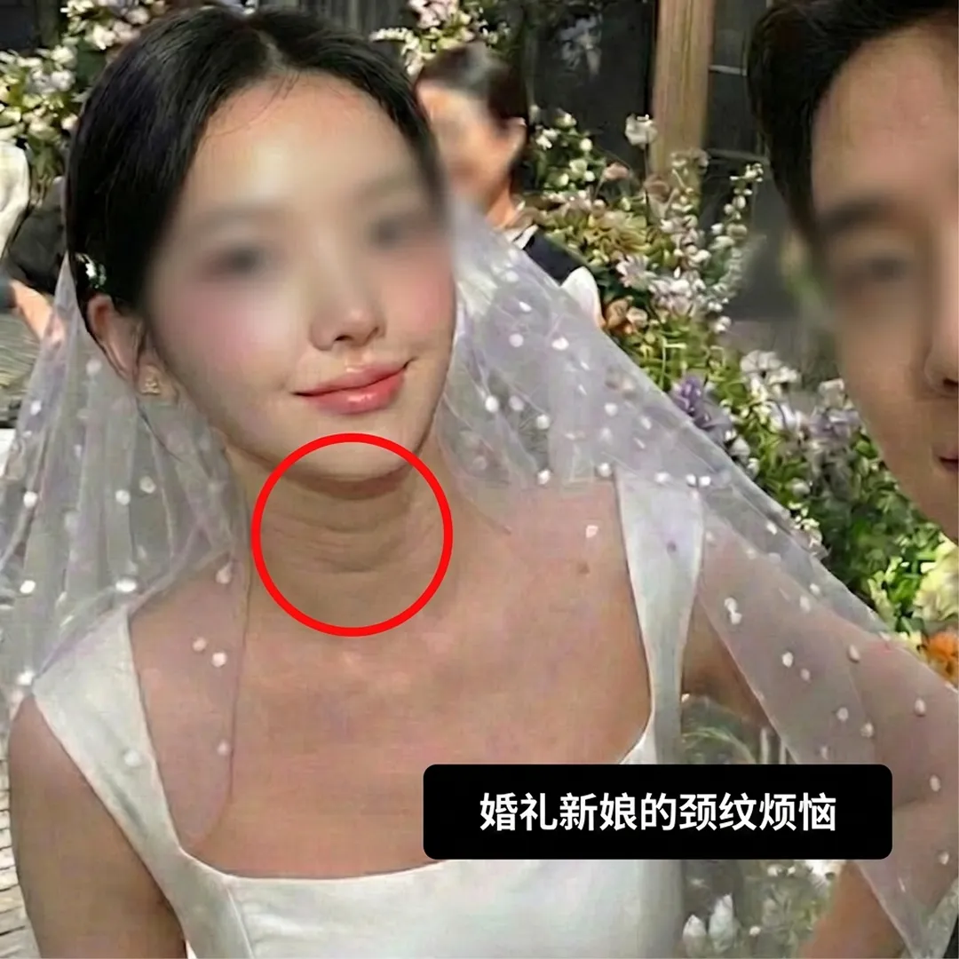 결혼-예신-피부과-治疗-목주름-婚礼新娘的颈纹烦恼-zh-cn.webp