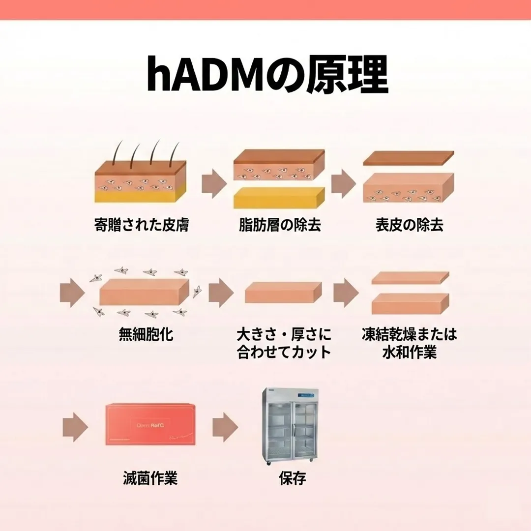 리투오 원리 hADM-1.webp