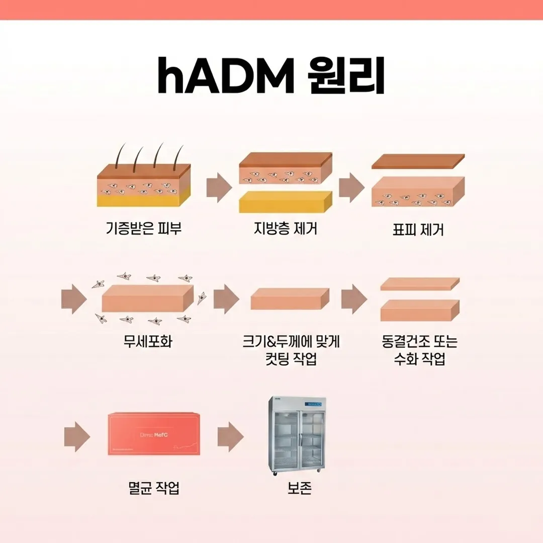 리투오 원리 hADM.webp