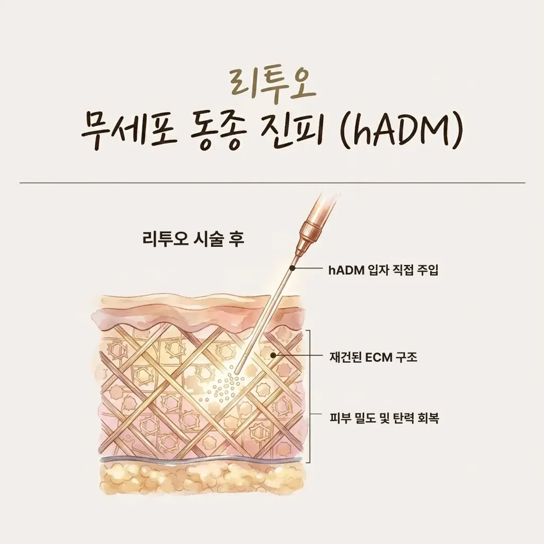 리투오-스킨부스터-원리.webp
