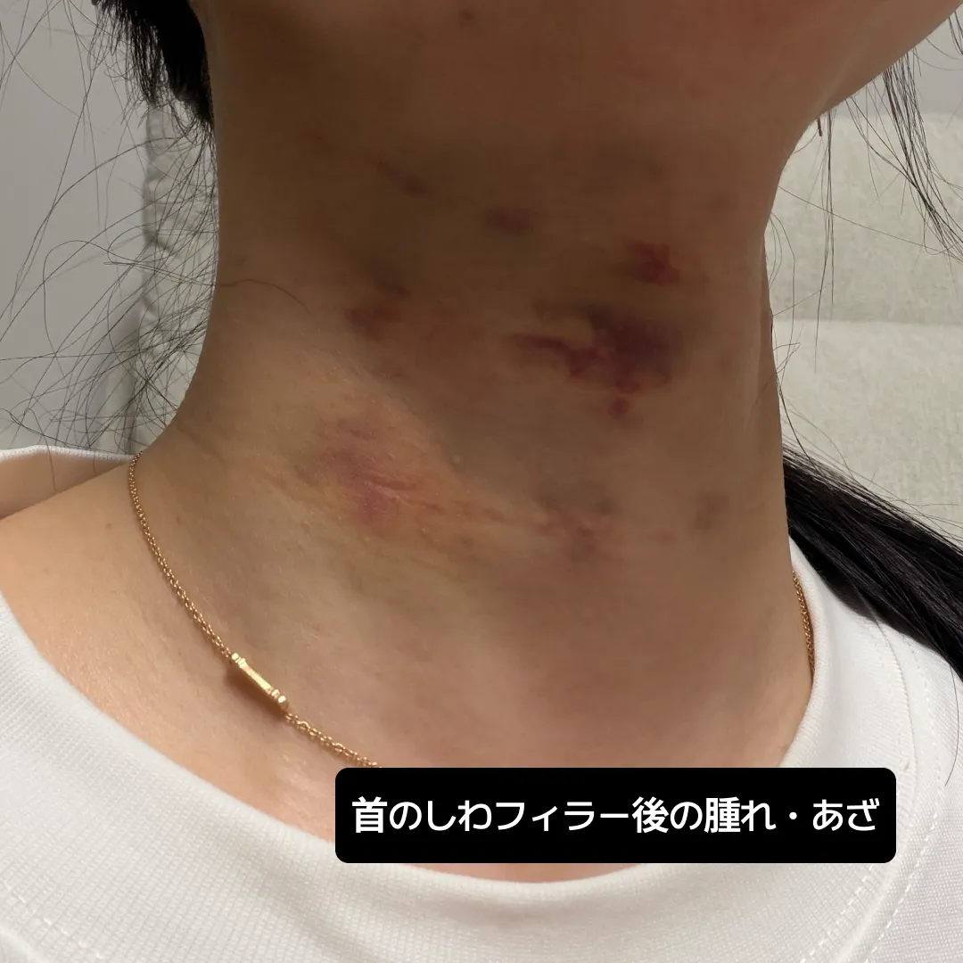 首フィラー　レディエッセ　ベレテロ　首のしわ
