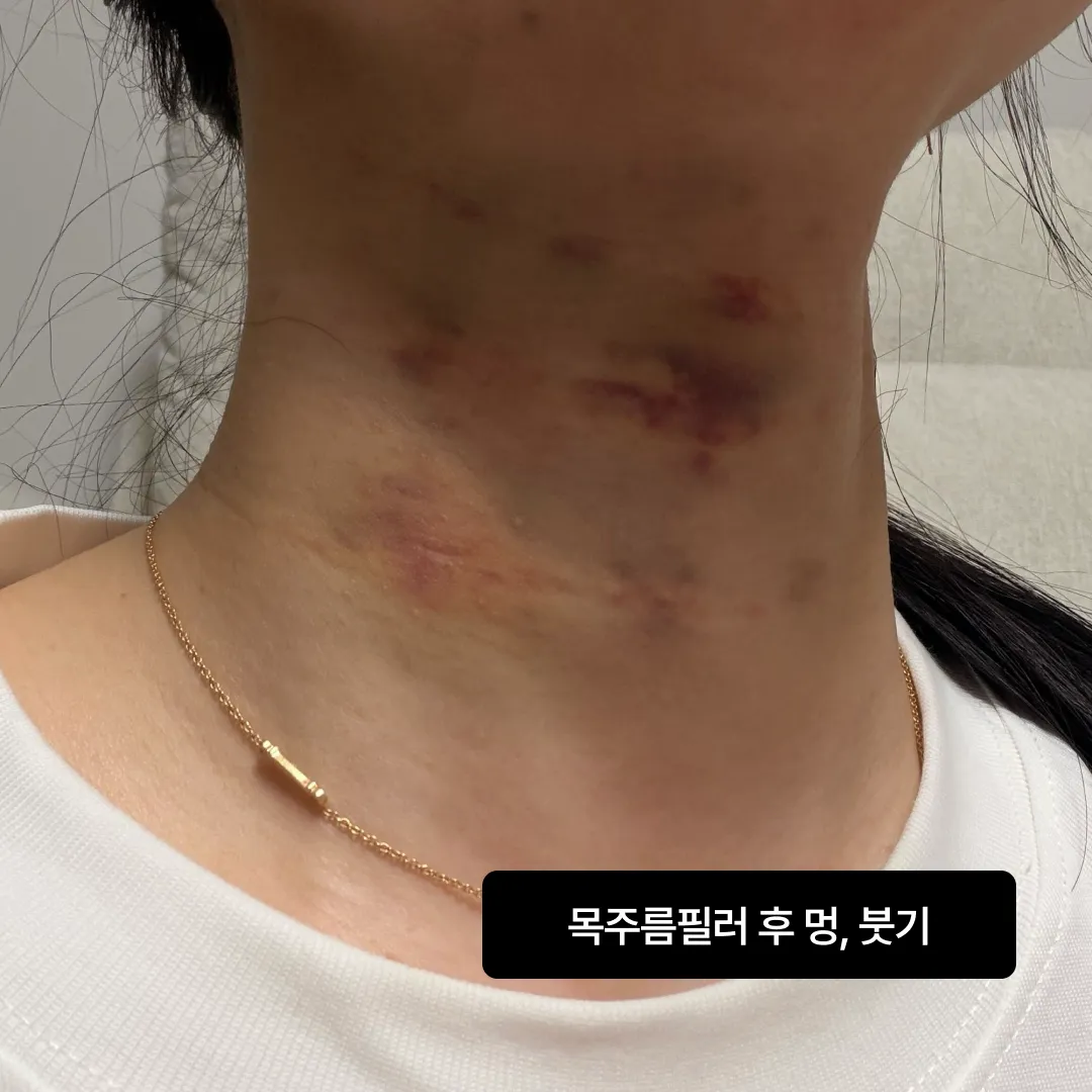 목주름필러 멍 붓기.webp