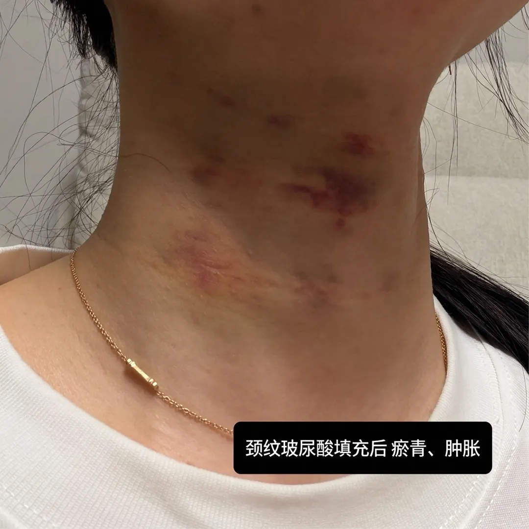 목주름필러-멍-붓기-颈纹玻尿酸填充后-瘀青、肿胀-zh-cn.webp