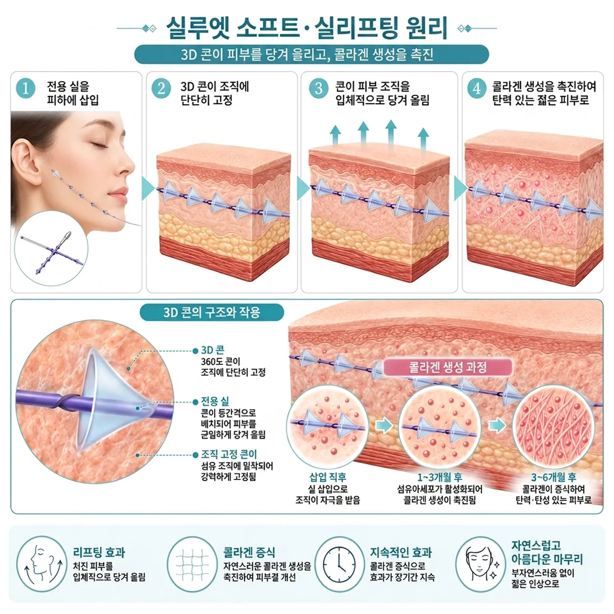 실리프팅 원리.webp