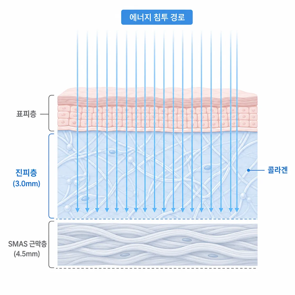써마지-FLX-원리-진피층-고주파-침투-구조.webp