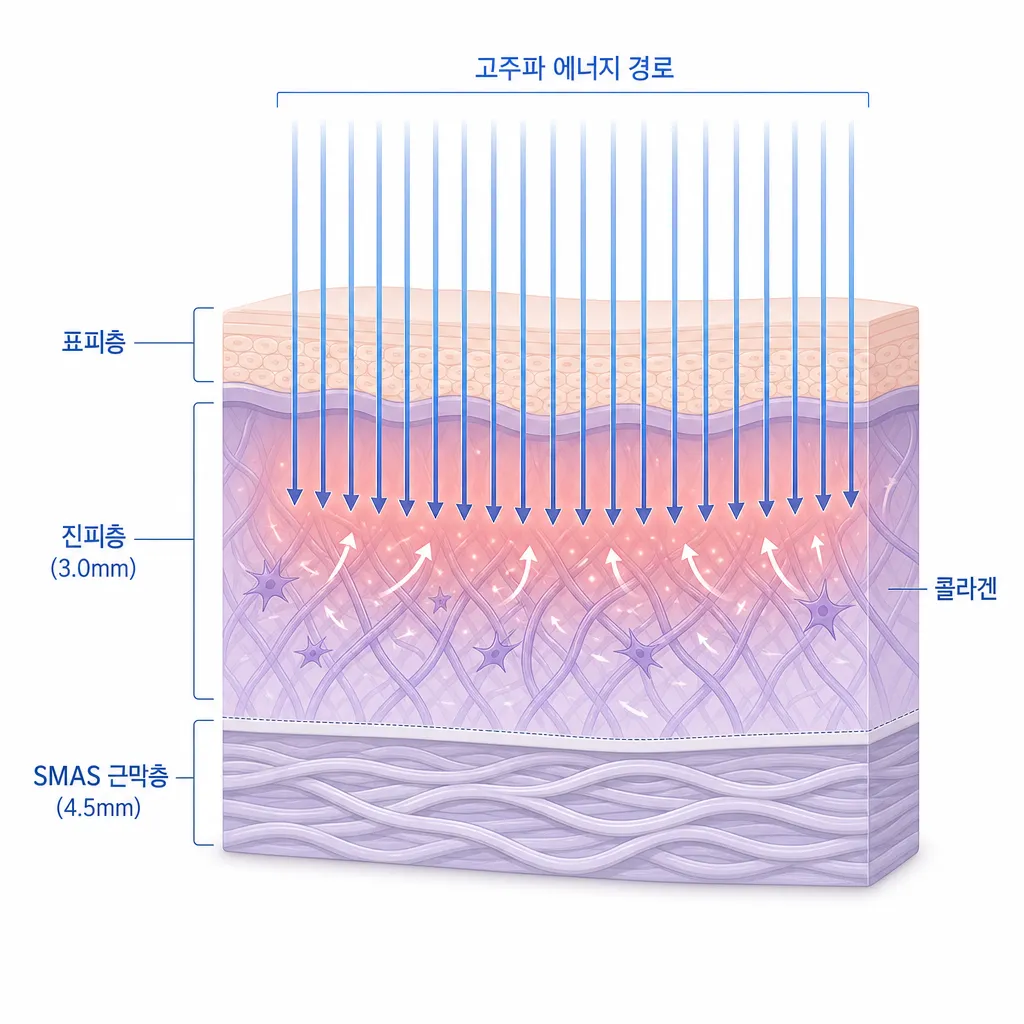 써마지 FLX 작용 원리 진피층 고주파 에너지 침투