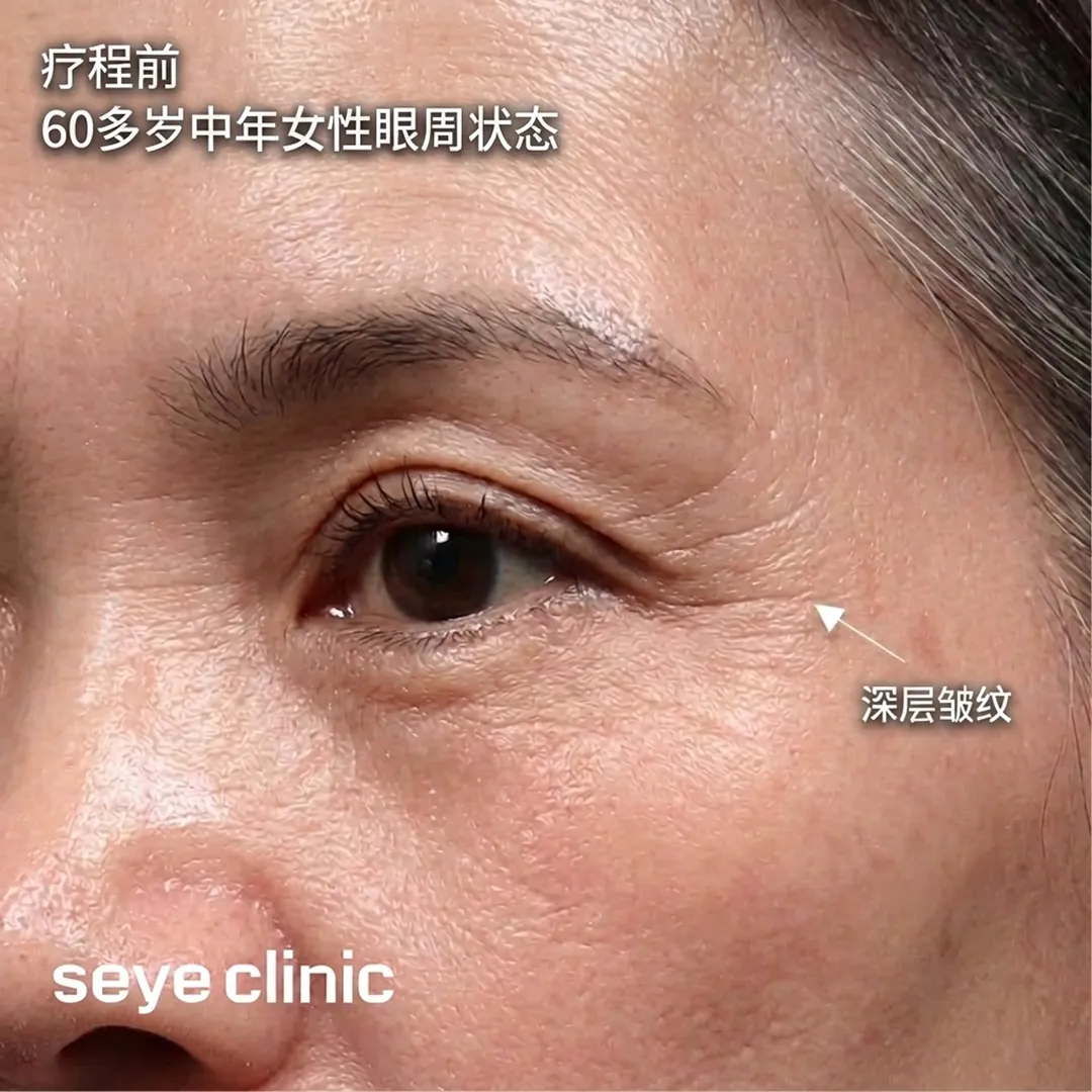 아이써마지-眼周热玛吉評價-seye-clinic-zh-cn.webp