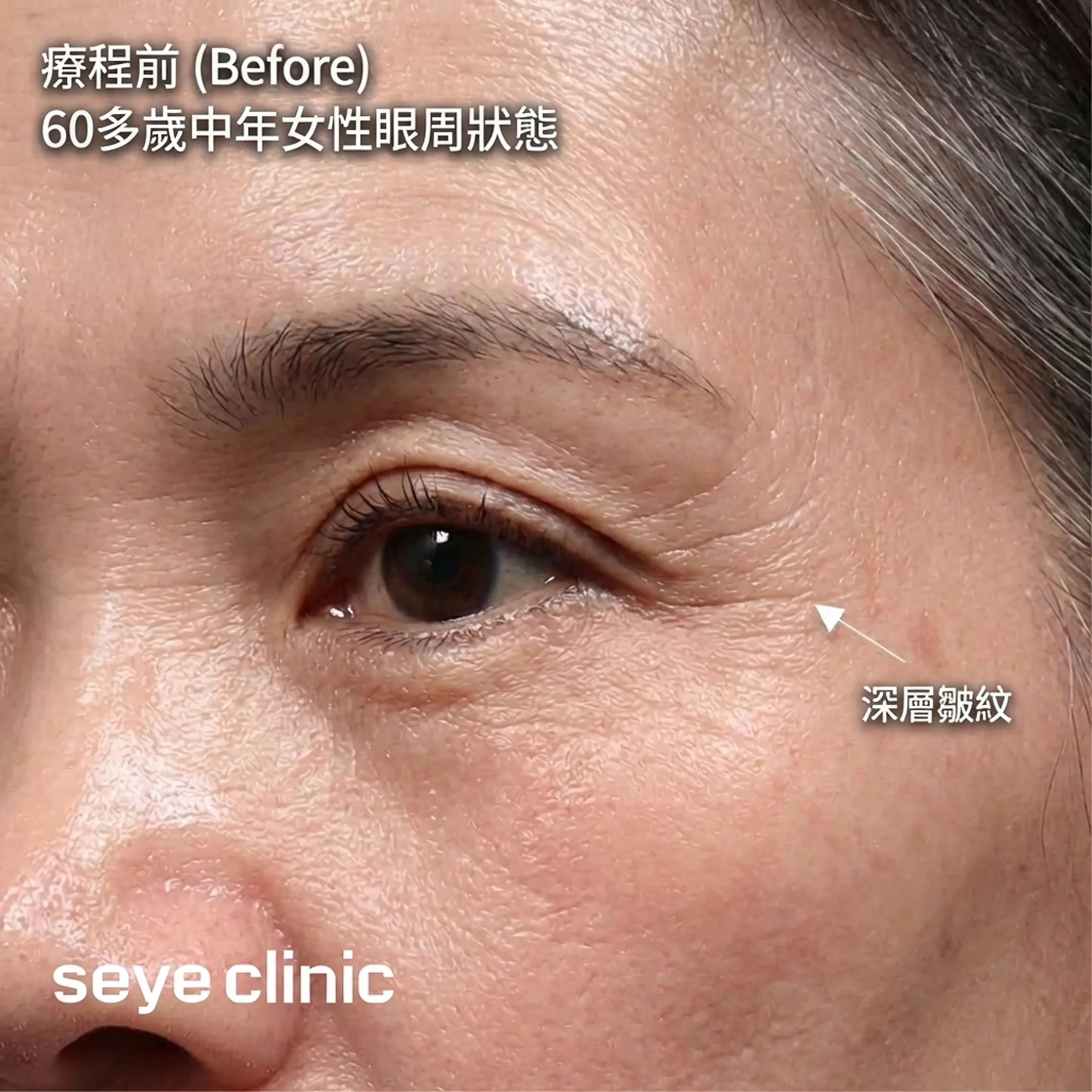 아이써마지-評價-seye-clinic-療程前-Before-60多歲中年女性眼周狀態-深層皺紋-眼周皺紋改善-zh-tw.webp