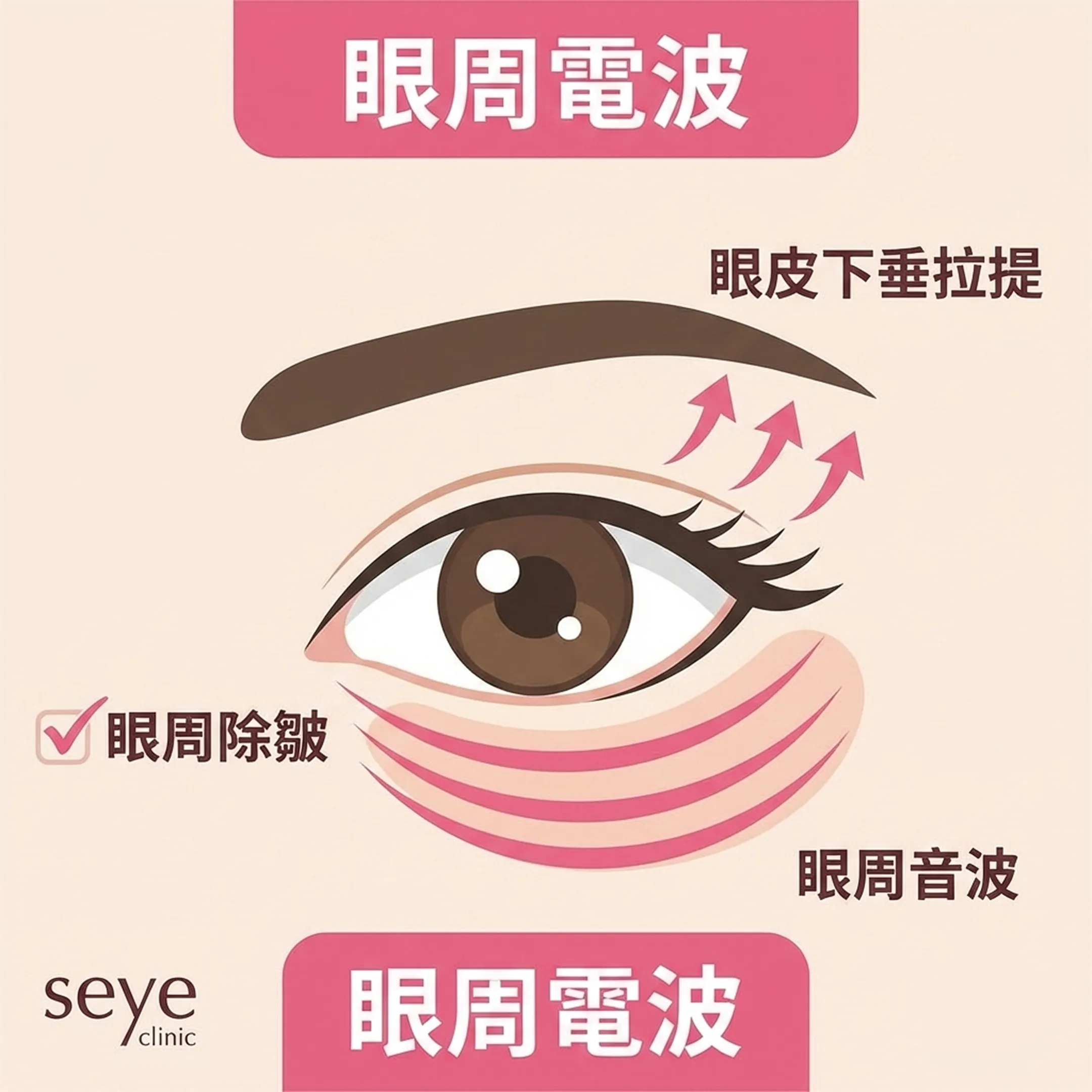 아이써마지-아이울쎄라-seye-clinic-眼周電波-眼皮下垂-眼周音波-zh-tw.webp