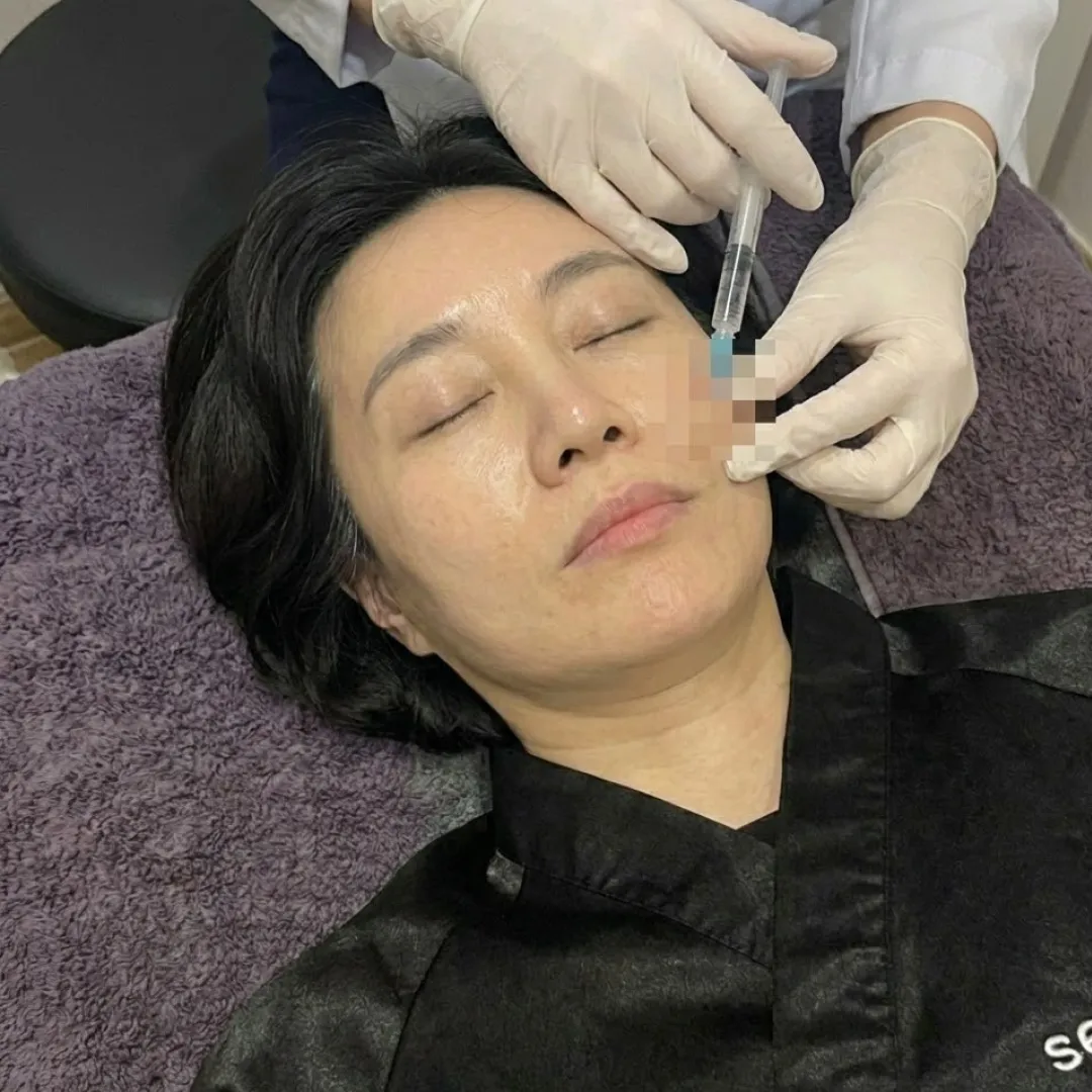 엘란쎄 필러 전후.webp
