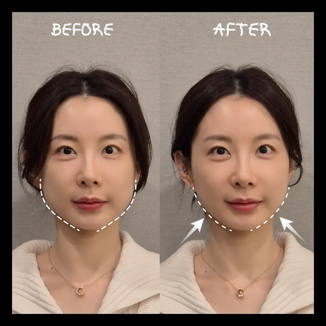 옥순리프팅 옥순올타이트.webp