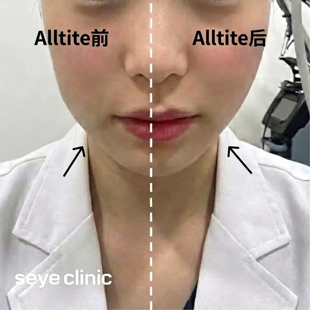 올타이트리프팅-評價-seye-clinic-Alltite前-Alltite后-Alltite後-zh-cn.webp