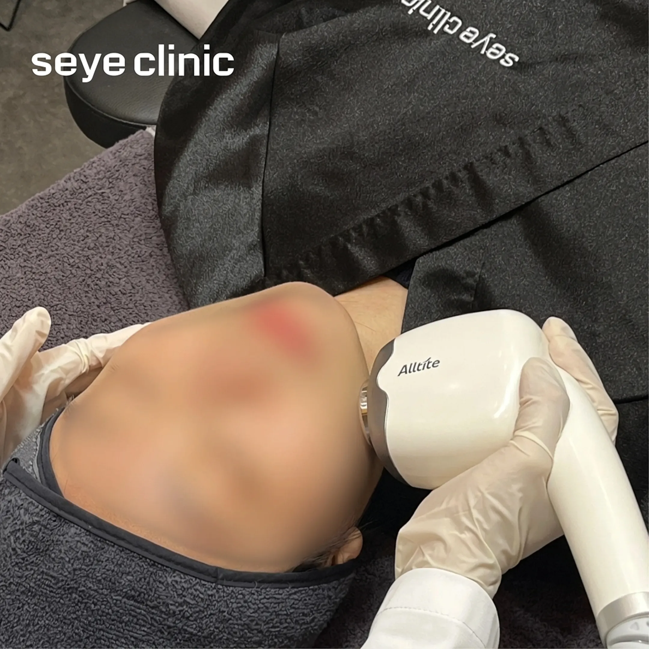 올타이트-評價-診所-seye-clinic-Alltite-zh-tw.webp