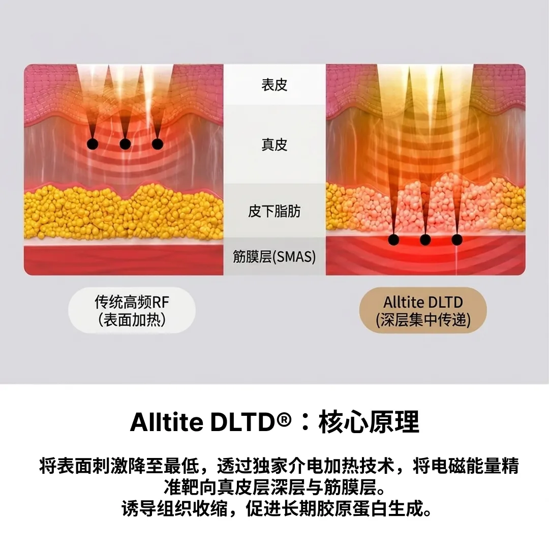올타이트-리프팅-原理-DLTD-Alltite-深层集中传递-DLTD®:核心原理-表面刺激降至最低,将高频能量集中传递至真皮下层与筋膜层。-筋膜层-SMAS-zh-cn-1.webp