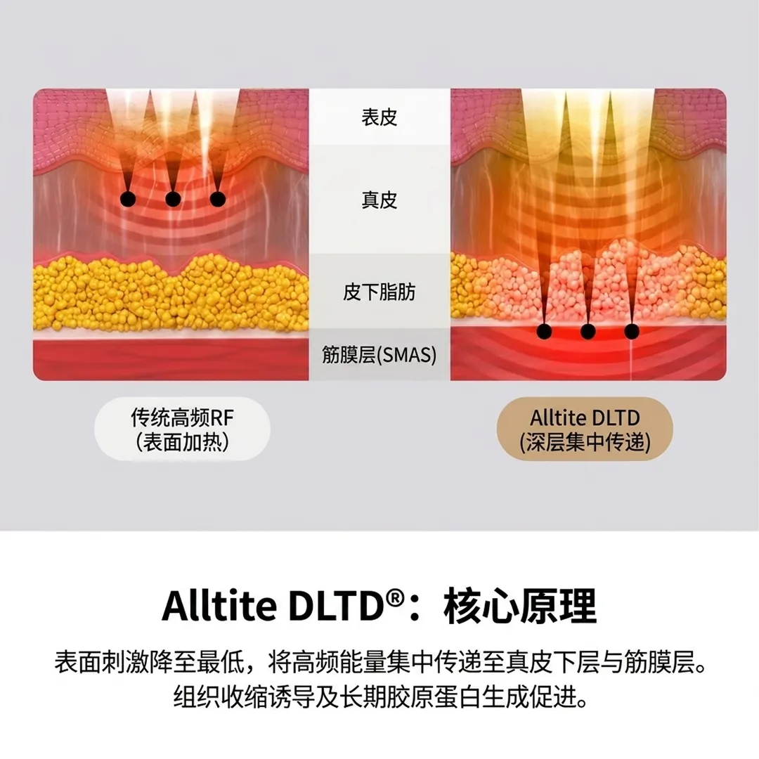 올타이트-리프팅-原理-DLTD-Alltite-深层集中传递-DLTD®:核心原理-表面刺激降至最低,将高频能量集中传递至真皮下层与筋膜层。-筋膜层-SMAS-zh-cn.webp