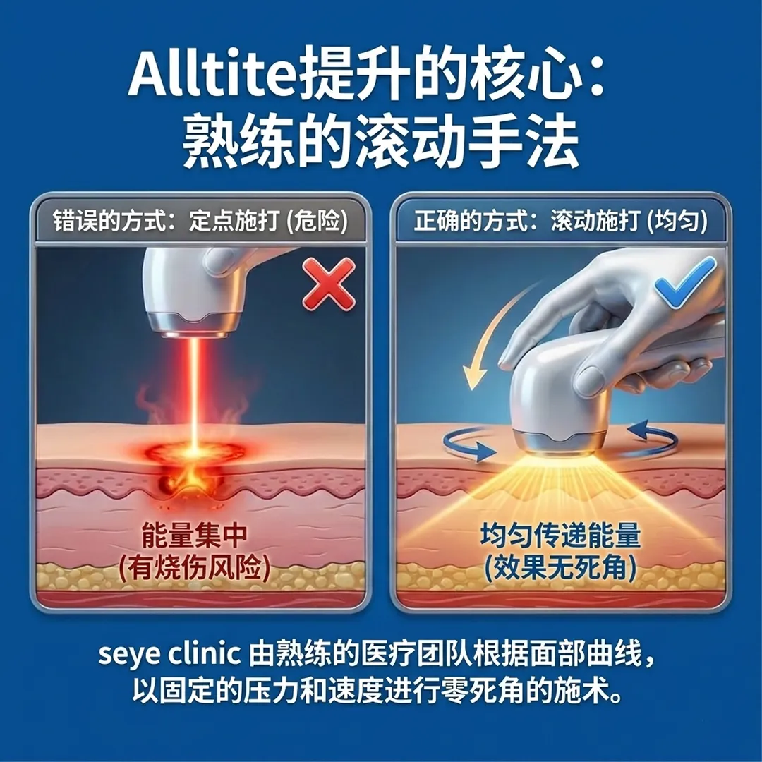 올타이트-리프팅-诊所-seye-clinic-由熟练的医疗团队根据面部曲线，以固定的压力和速度进行零死角的施术。-错误的方式：定点施打-危险-正确的方式：滚动施打-均匀-zh-cn.webp