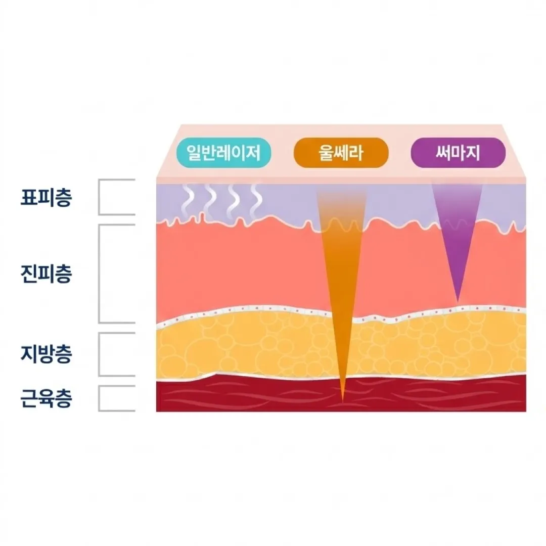 울쎄라 써마지 차이.webp