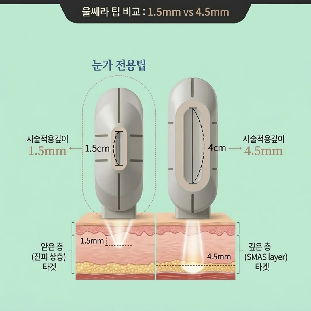 울쎄라 팁 비교-4.webp