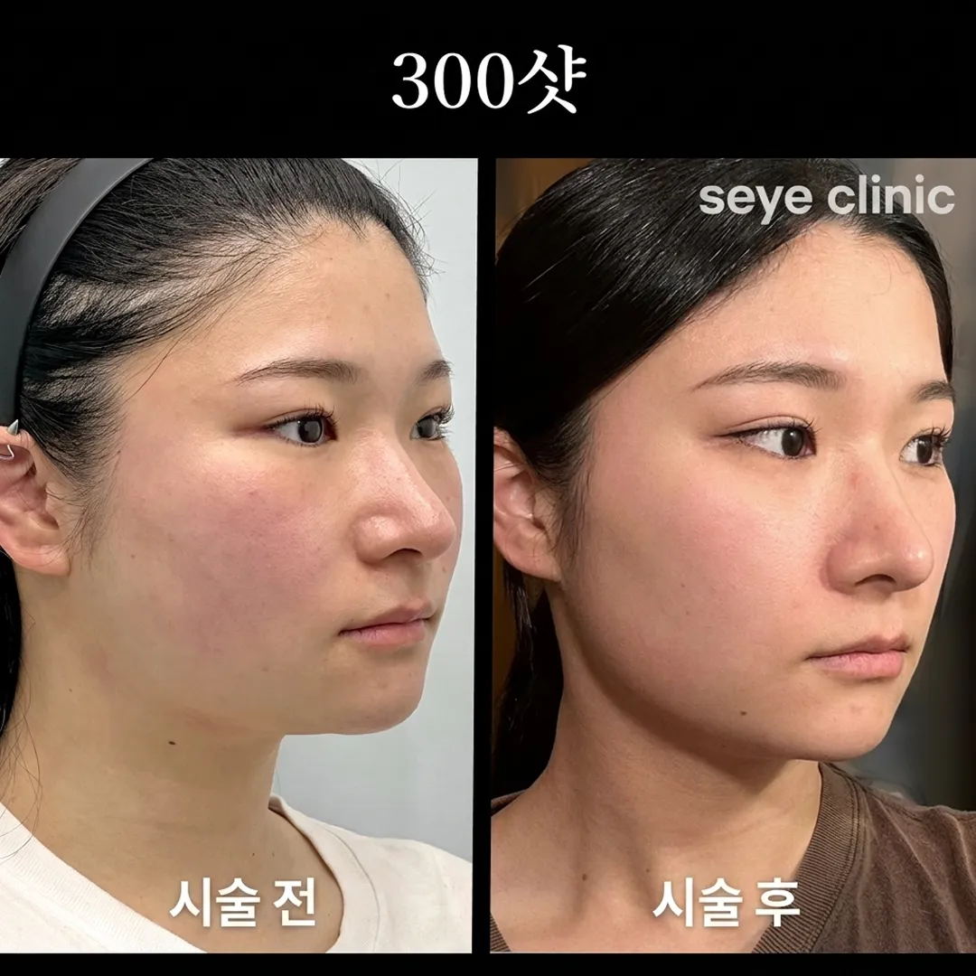 울쎄라 300샷 전후-1.webp
