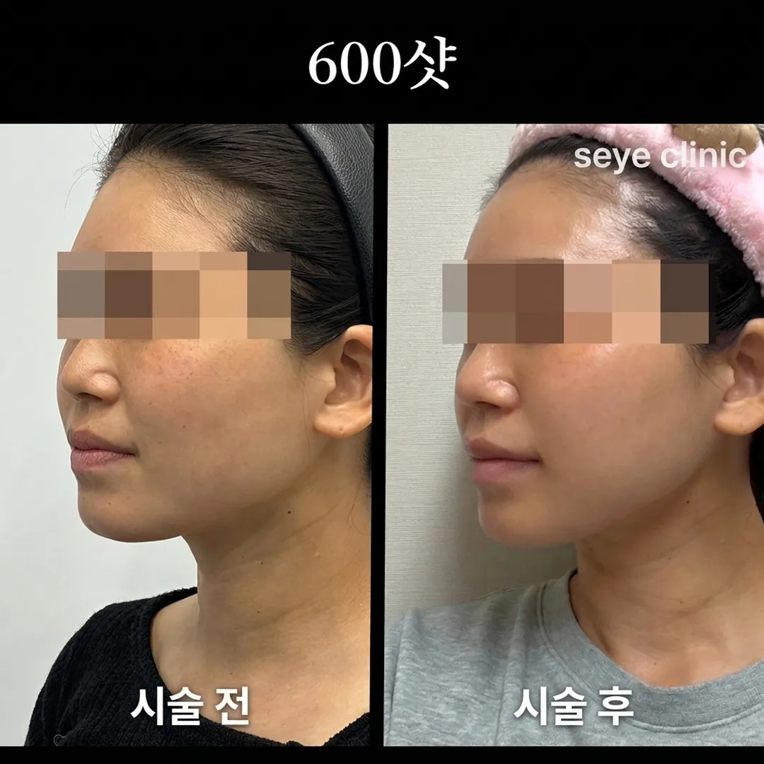 울쎄라 600샷 후기-1.webp