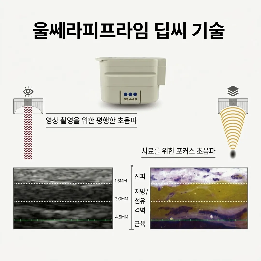 울쎄라피프라임 효과 특징.webp