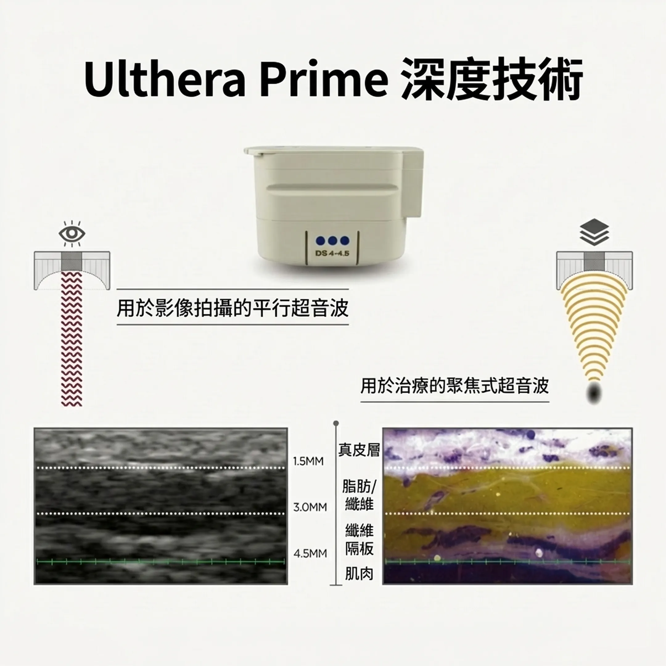 울쎄라피프라임-效果-특징-DS-4-5-Ulthera-Prime-1-5MM-3-0MM-zh-tw.webp