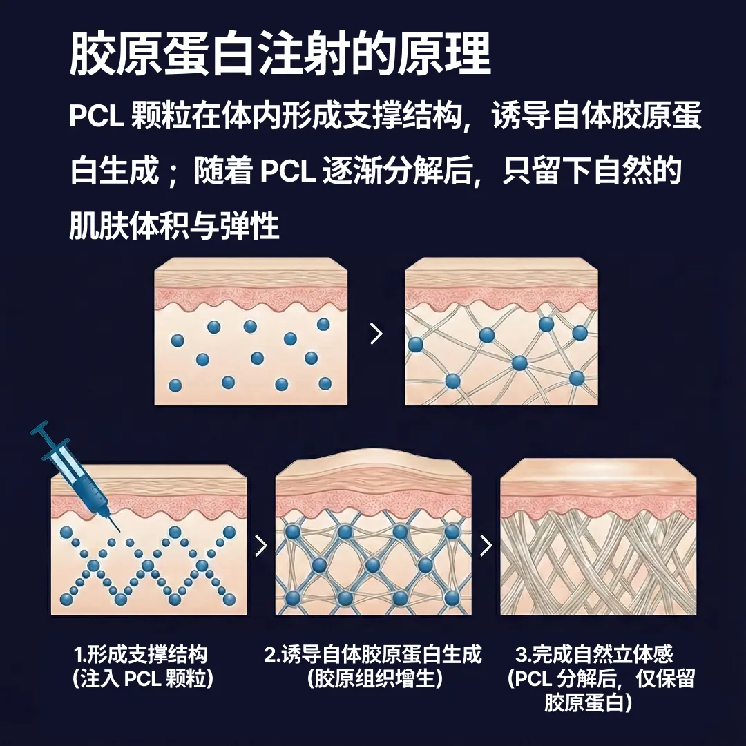 콜라겐주사원리.webp