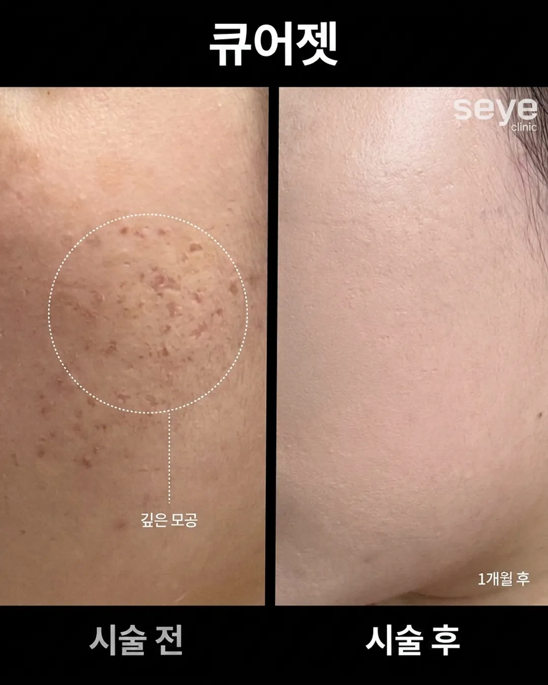큐어젯 전후_1.webp