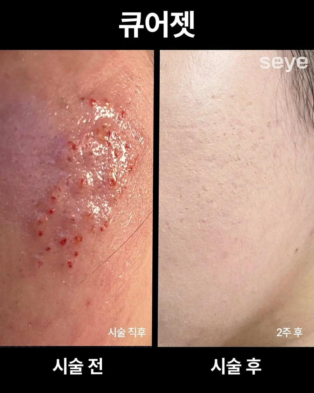 큐어젯 전후_2.webp