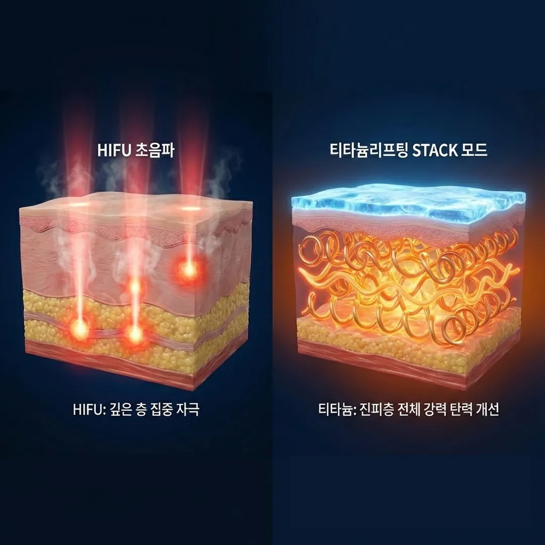 티타늄리프팅 차이.webp