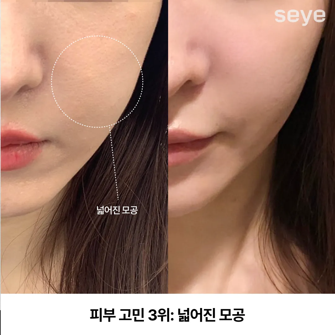 피부 고민 모공 축소.webp
