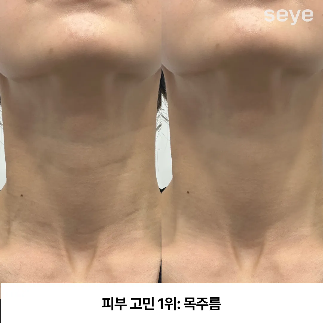 피부 고민 목주름.webp